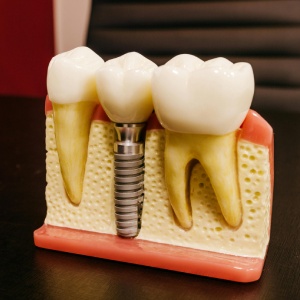 5 Myths and Facts About Dental Implants in Raleigh