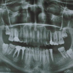 Xray showing an impacted wisdom tooth