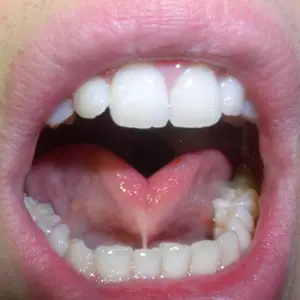 Tongue-tie | Tongue-tie Treatment | Cary and Raleigh, NC Tongue-tie | Tongue-tie Treatment | Cary and Raleigh, NC