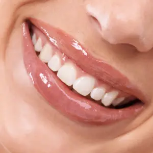 Teeth Whitening