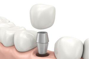 Implant Dentistry