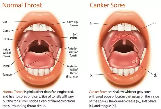 Canker Sore Info Smiles of Cary