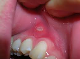 Canker Sore